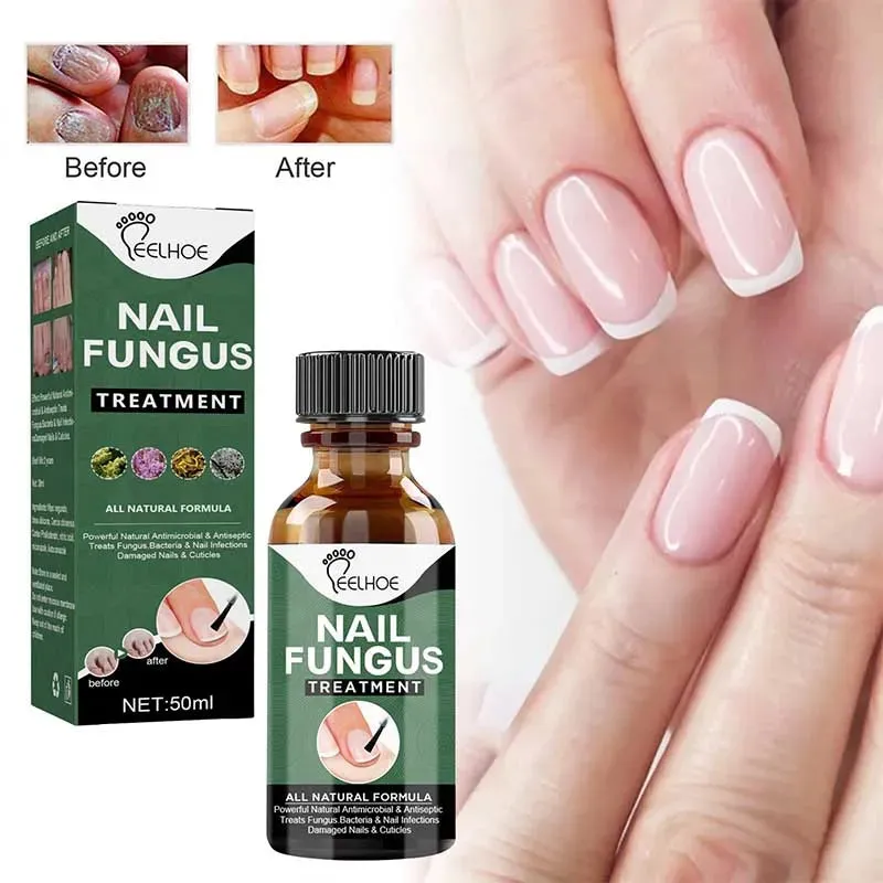 Anti-Funguses Nail Treatment