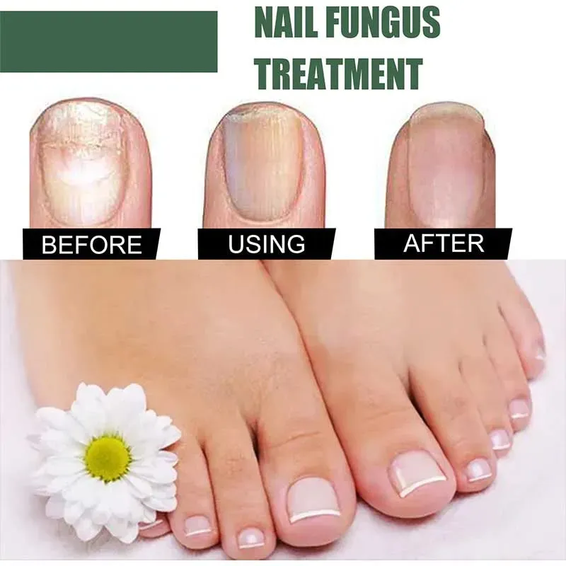 Anti-Funguses Nail Treatment